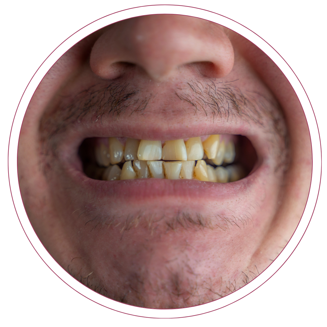 clareamento dental novo hamburgo - rs